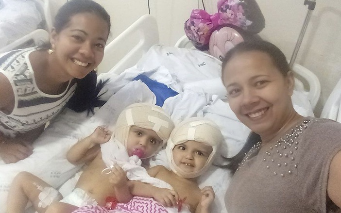 Médico diz que 6ª cirurgia em uma das irmãs que nasceram unidas pelo crânio será mais simples