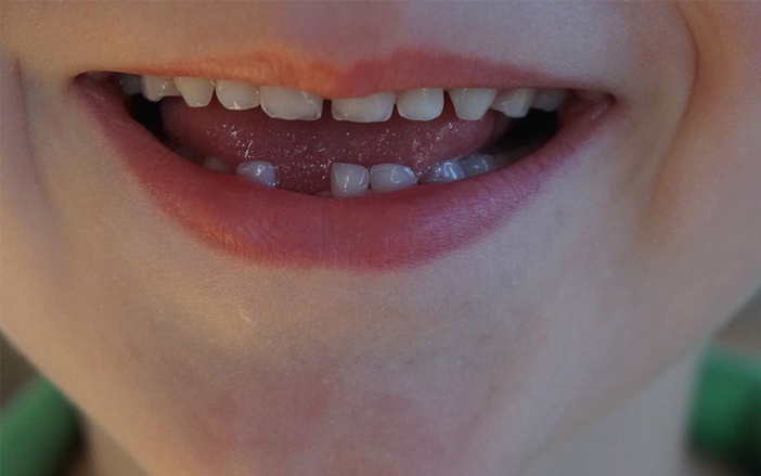 USP faz campanha para arrecadar dentes de leite