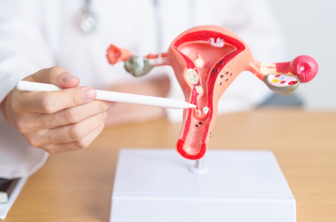 Março Amarelo alerta para o impacto da endometriose na saúde e fertilidade feminina
