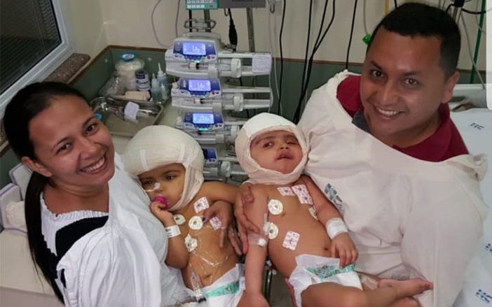 Após separação, irmãs siamesas já estão acordadas e conscientes